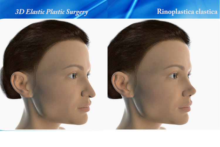 3D Rinoplastica elastica risultato